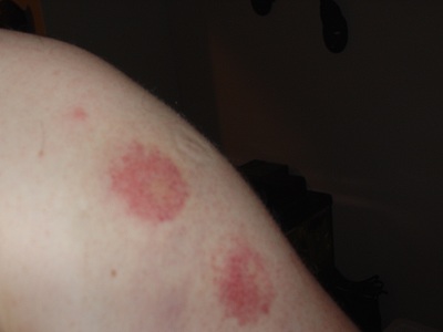 paintball_bruises.jpg